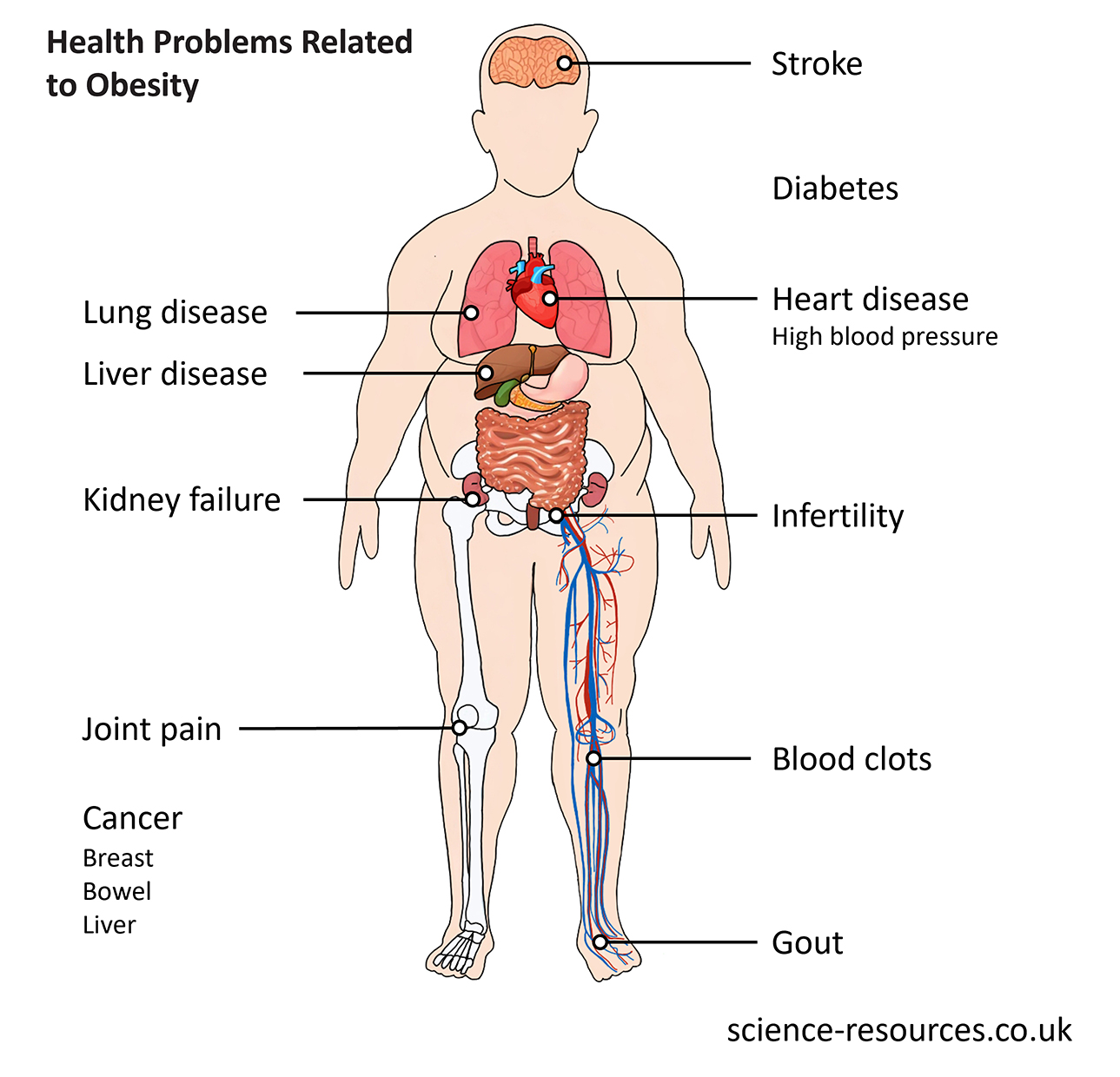 Image showing health problems related to obesity